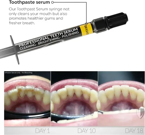 Vista 5 de Bilistic Pro-Series - Pulidor de dientes y luz LED para blanquear los dientes, pulidor profesional en casa con pieza de mano con cable y suero